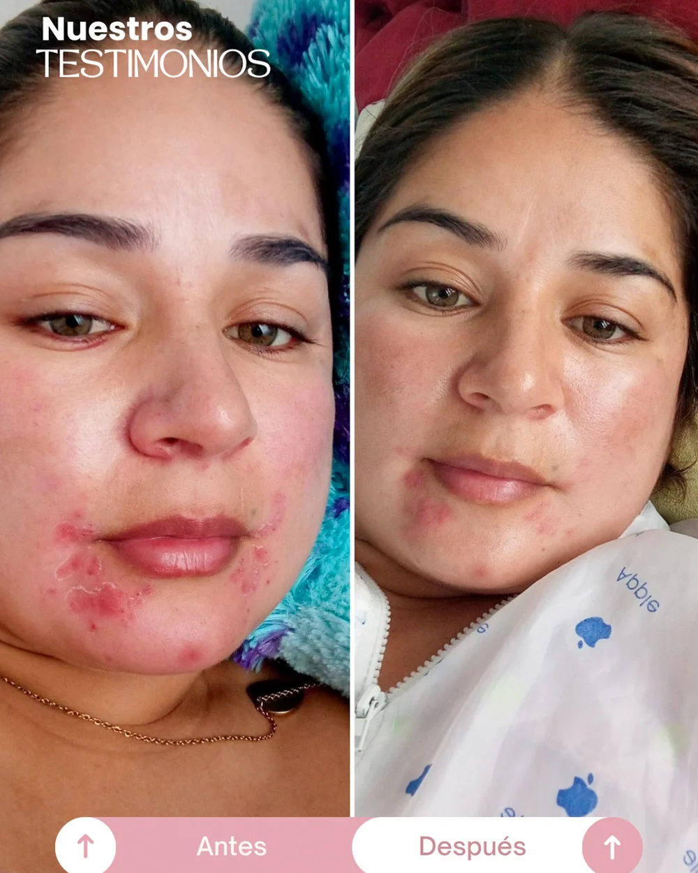 testimonios del tonico despigmentante princess skin (6)